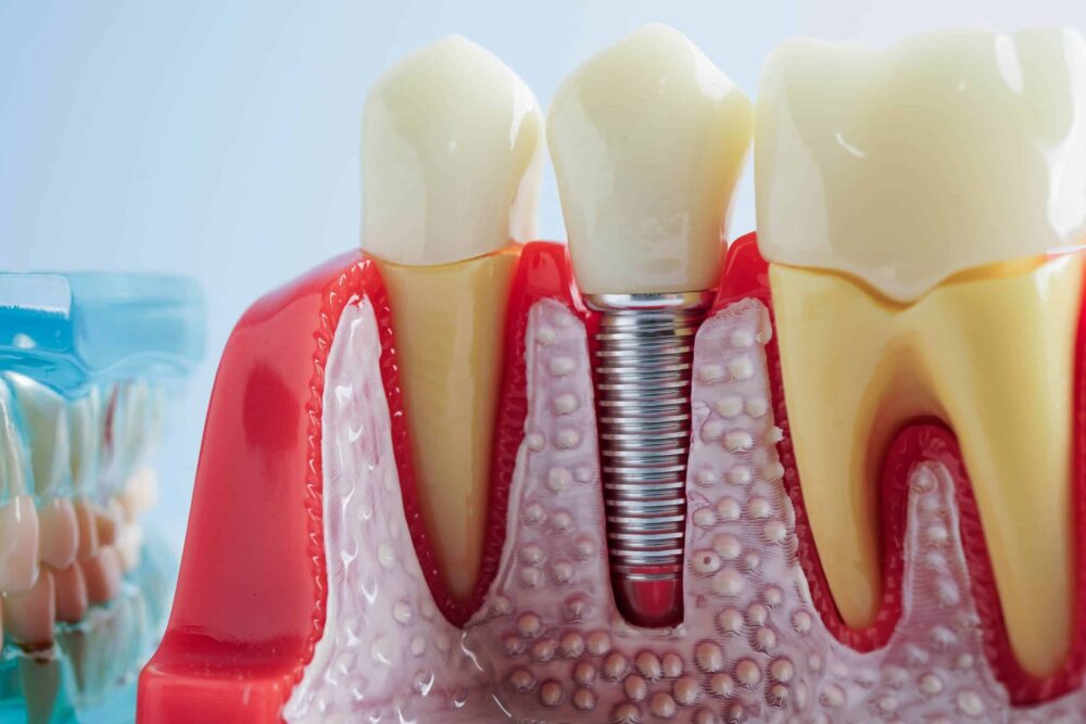 Benefits of All-on-X dental implants Omaha